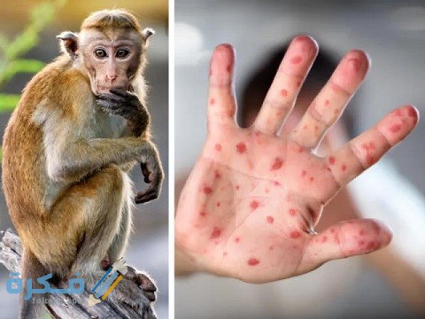 أماكن انتشار جدري القرود في العالم