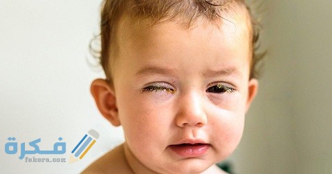 أسباب ضمور العصب البصري عند الرضع