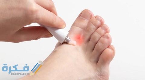 أفضل كريم للفطريات الجلدية