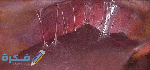 هل تظهر التصاقات الرحم بالسونار