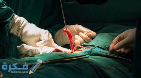 هل عملية الزائدة خطيرة