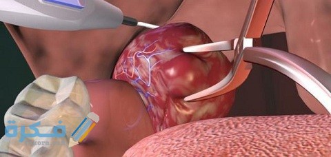 هل عملية اللوز خطيرة