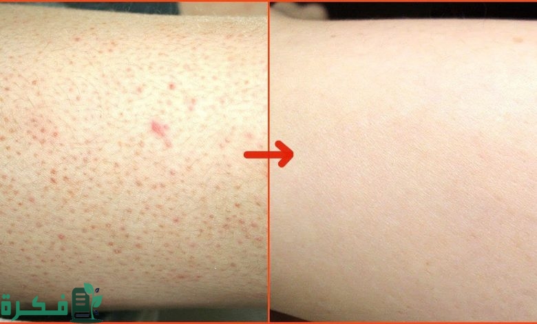 التخلص من الشعر تحت الجلد في جميع المناطق في الجسم 780x470 1