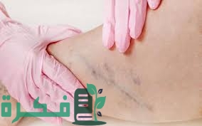 تجربتي مع جلطة الساق 3 5D8D2D42 F75D 43EE 855A 00891AD293A4