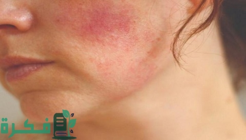 هل يوجد كريم طبي لعلاج حساسية الوجه