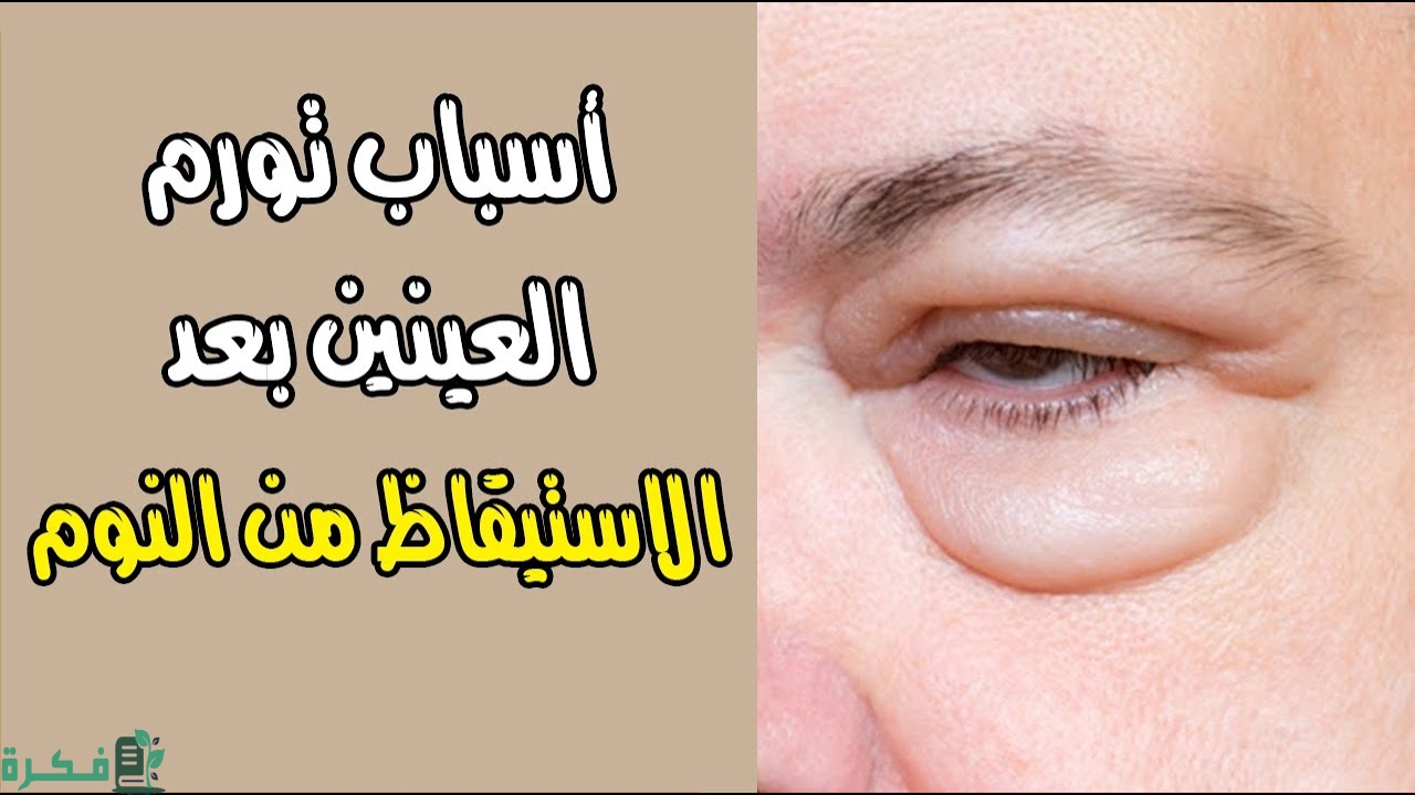 سبب معاناتي من تورم العينين بعد استيقاظي من النوم 28 وسائل طبيعية للحفاظ على صحة العين