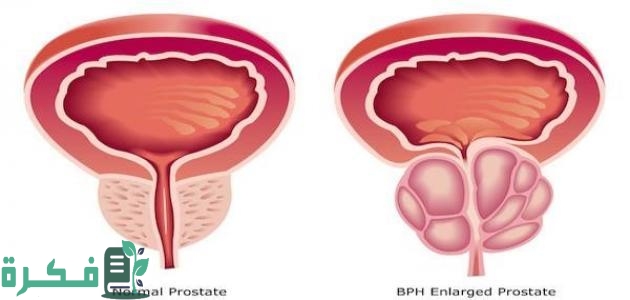 هل شرب الماء يعالج التهاب البروستاتا 24 علاج التهاب البروستاتا