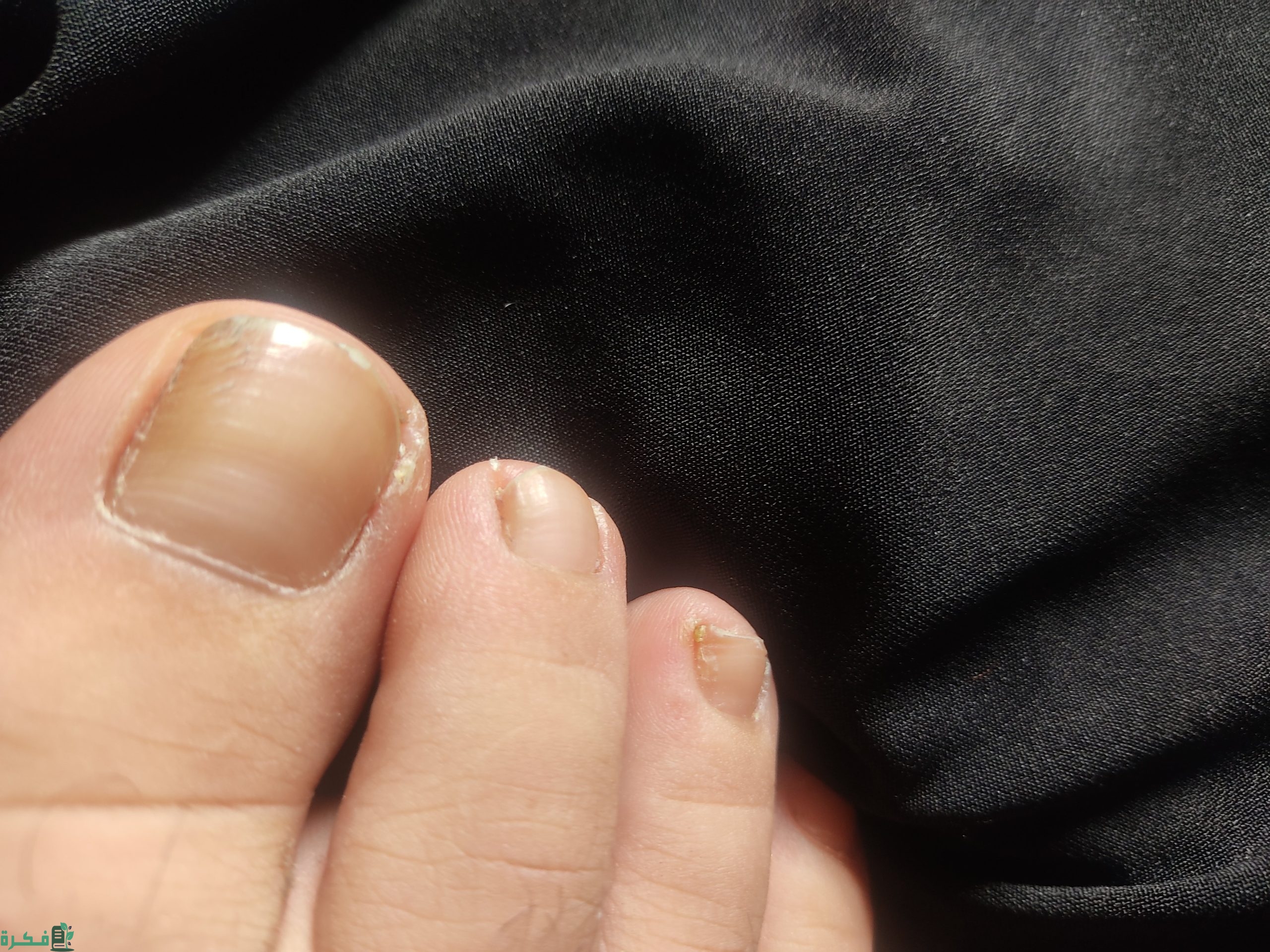ما سبب اصفرار أظافر القدمين 3 b8e06ab67dd3c4e643779dbb1f230e5b scaled