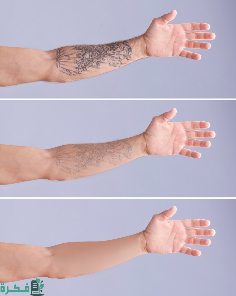 قبل وبعد إزالة الوشم بالليزر
