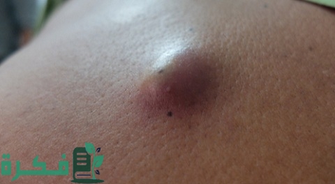 ما سبب ظهور حبة صغيرة تحت الجلد في البطن