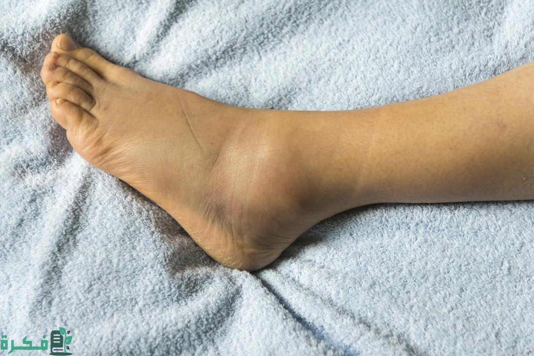 اسماء التحاليل المطلوبة لتورم القدمين 5 127026 اسباب تورم القدمين 1