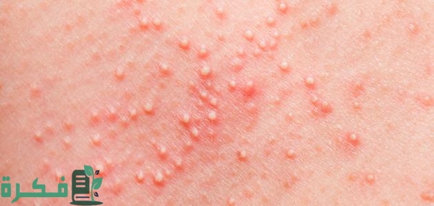 أنواع الحبوب الجلدية