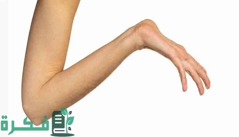 بحث عن متلازمة مارفان