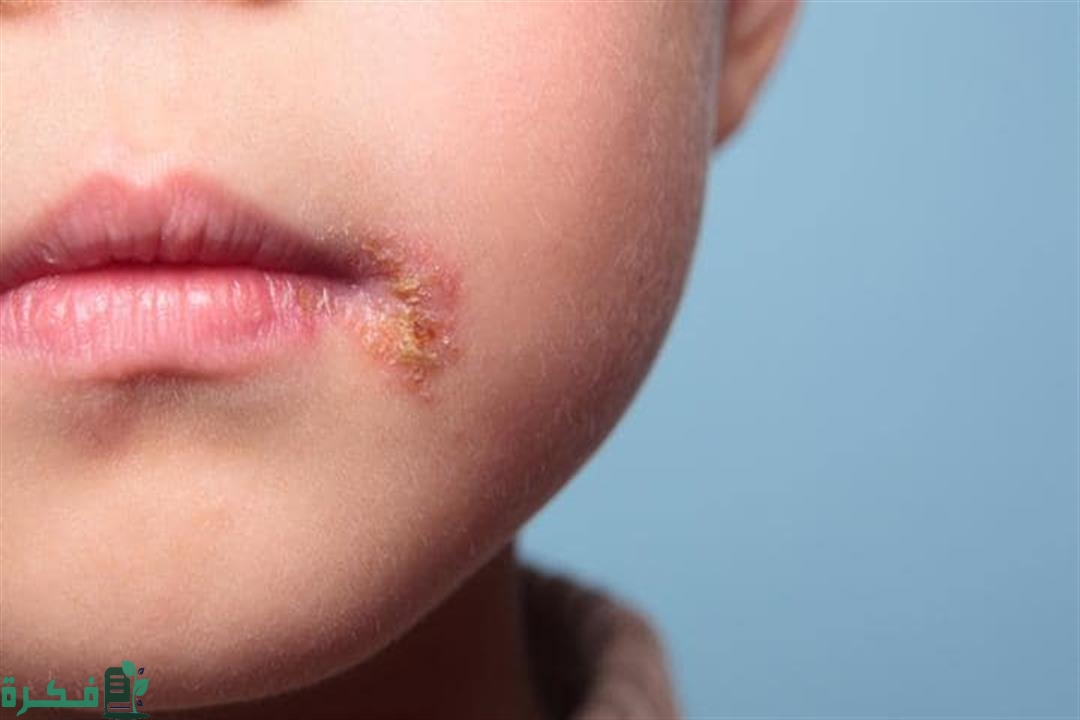 تجربتي مع الهربس الفموي عند الأطفال 