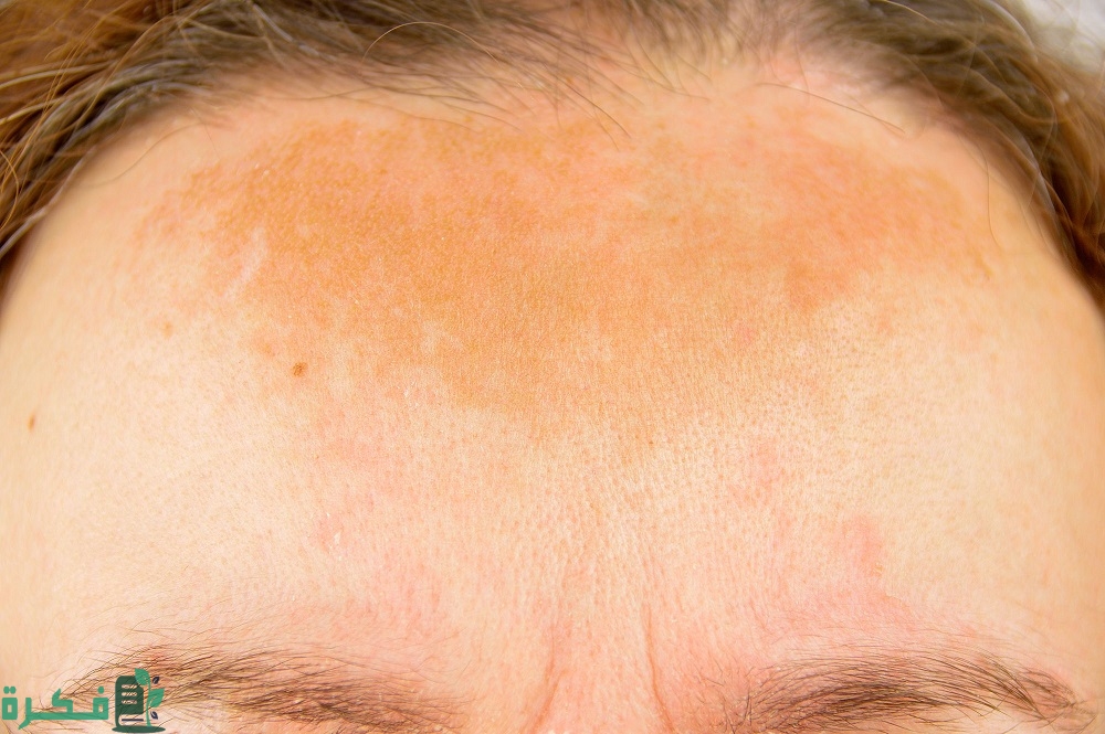 اسمرار الوجه بعد الديرما بن