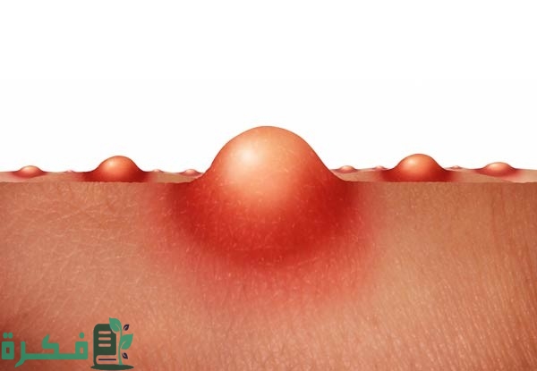 أسباب ظهور الحبوب في المؤخرة