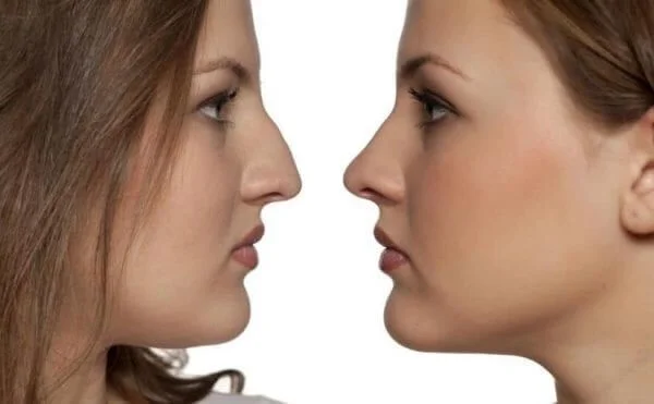 تكلفة عملية تجميل الانف في الرياض