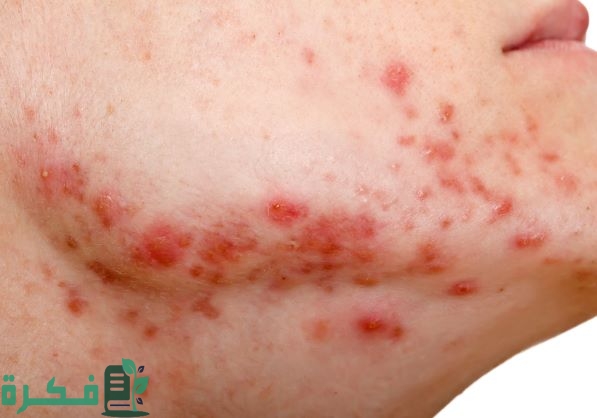 دواء حب الشباب من الصيدلية