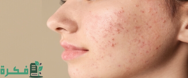  دواء حب الشباب من الصيدلية