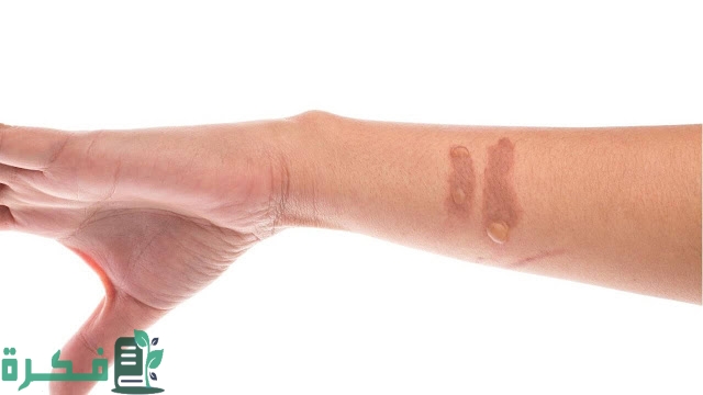 طريقة علاج آثار الحروق