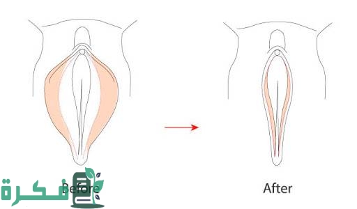 تجربتي مع عملية تجميل الأشفار 3 تجربتي مع عملية تجميل الأشفار