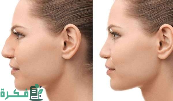 مراحل تغير الأنف بعد عملية التجميل