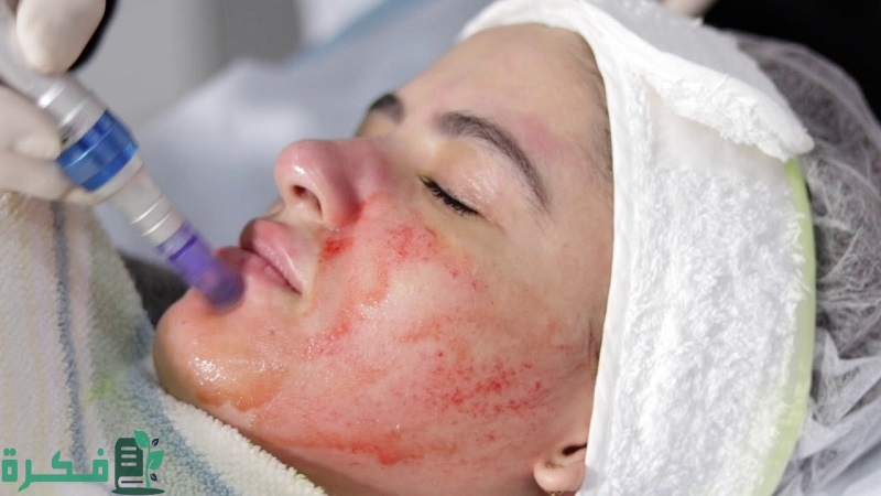 نتائج الديرما بن قبل وبعد