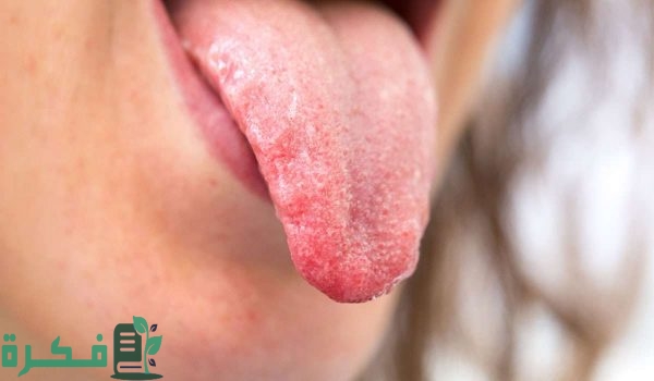 أسماء افضل 5 أدوية لعلاج التهاب اللسان 5 أفضل 5 أدوية لعلاج التهاب اللسان