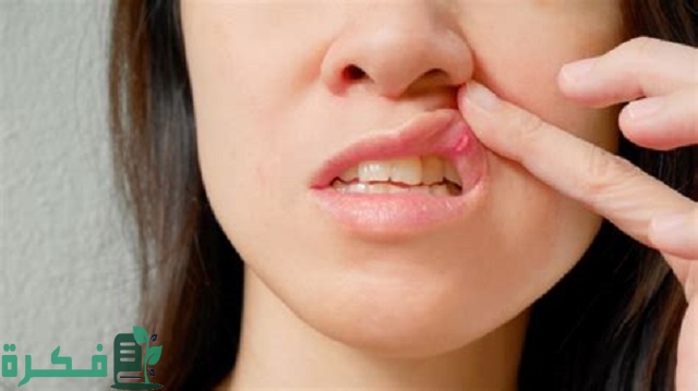 أفضل 5 أنواع مرهم لعلاج قرح الفم