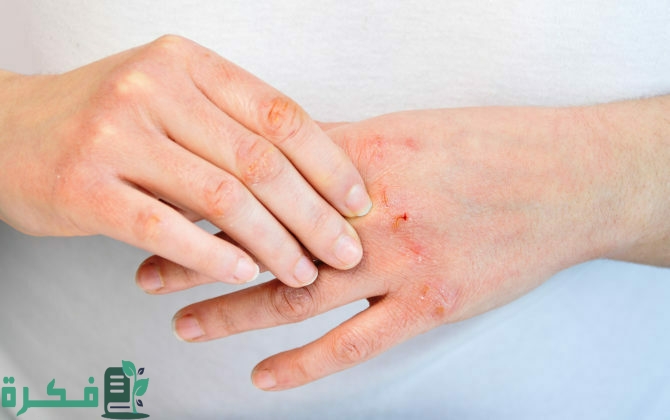 أسماء أفضل 5 أنواع كريم مضاد حيوي لعلاج التهابات الجلد