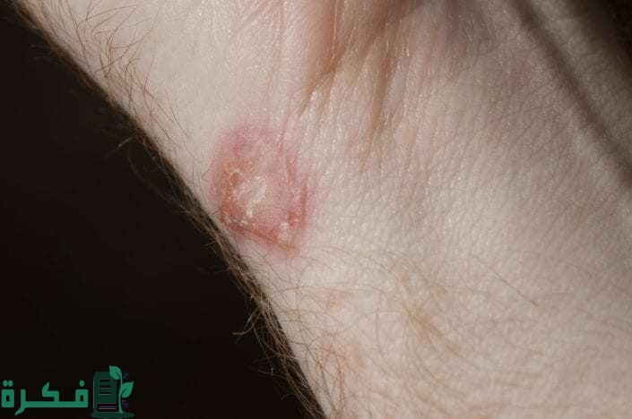 أفضل 5 أنواع مضاد حيوي لعلاج القوباء