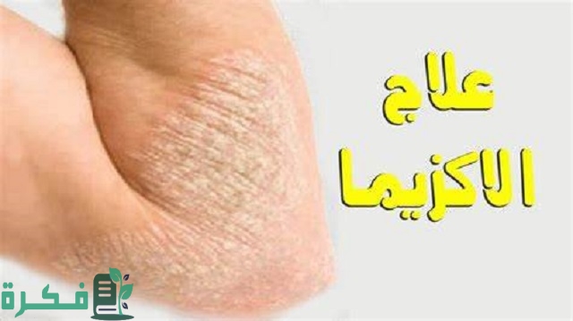 أفضل 5 أسماء كريمات لعلاج الصدفية