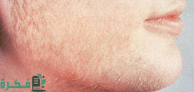 أفضل 5 أدوية علاج ارتفاع هرمون الذكورة عند النساء