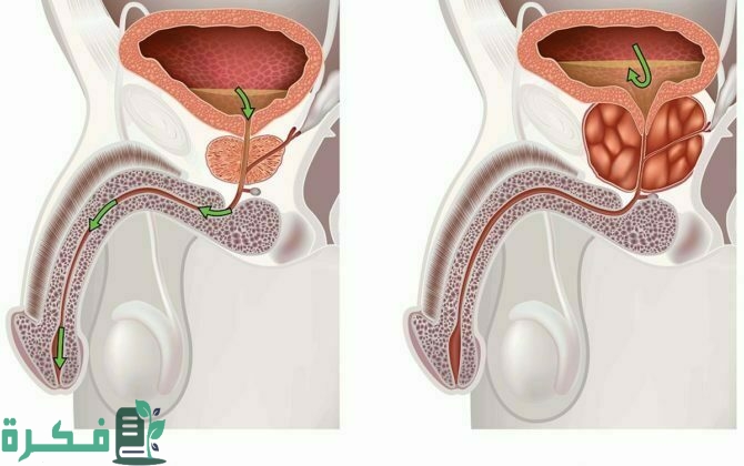 أفضل 5 أدوية علاج تضخم البروستاتا