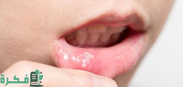 أفضل 5 أدوية علاج فطريات الفم للأطفال