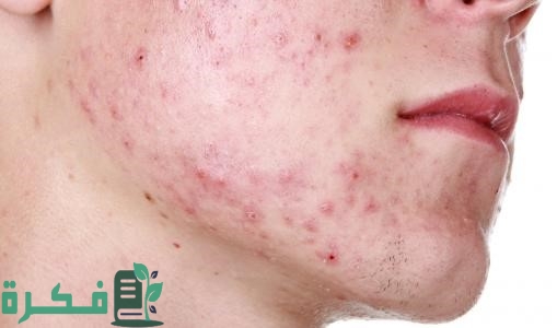 أسماء أفضل 5 أدوية علاج حب الشباب للبشرة الدهنية