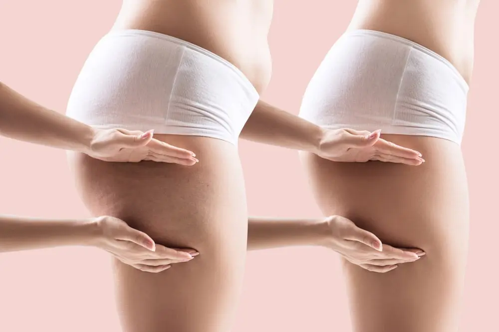 علاج السلوليت في المؤخرة