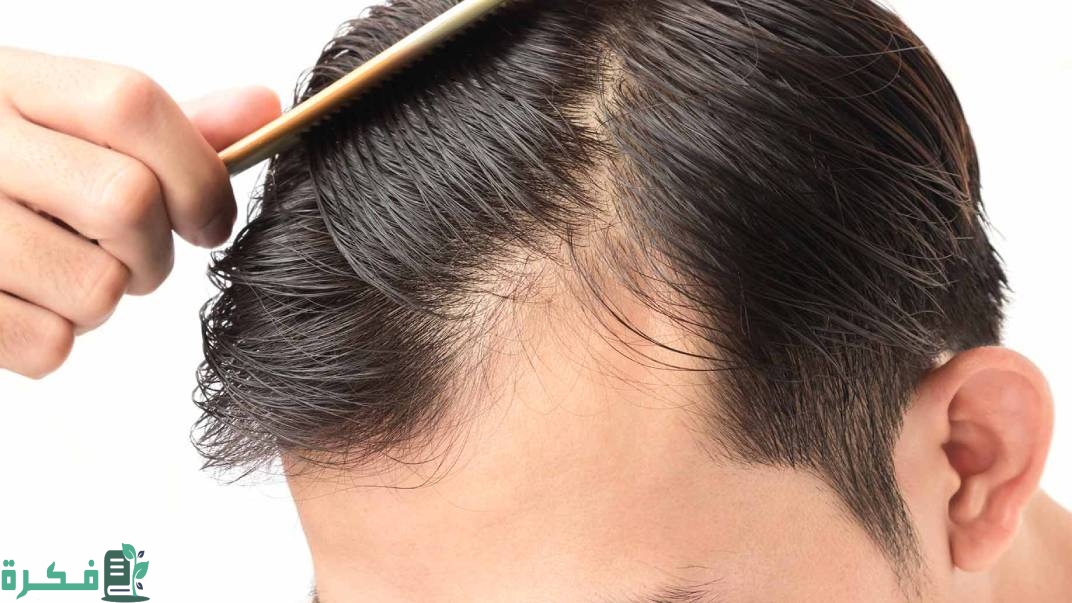 علاج تساقط الشعر والصلع في 12 يوم