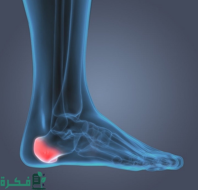 أفضل 5 أنواع مرهم لعلاج الشوكة العظمية