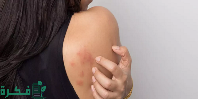 أفضل 10 حبوب حساسية الجلد والحكة