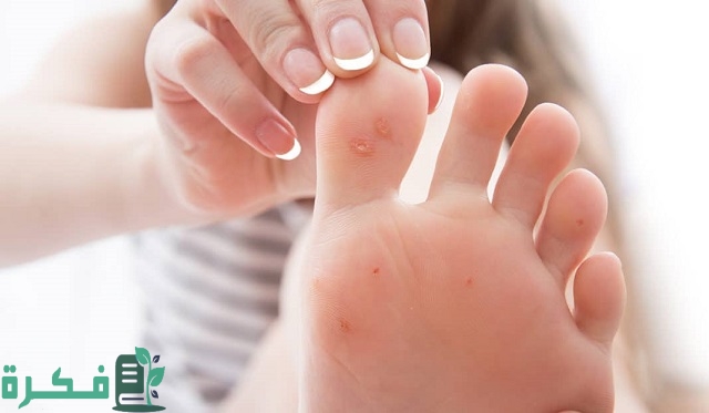 أسماء افضل 5 أدوية لعلاج عين السمكة 31 أفضل 5 أدوية لعلاج عين السمكة