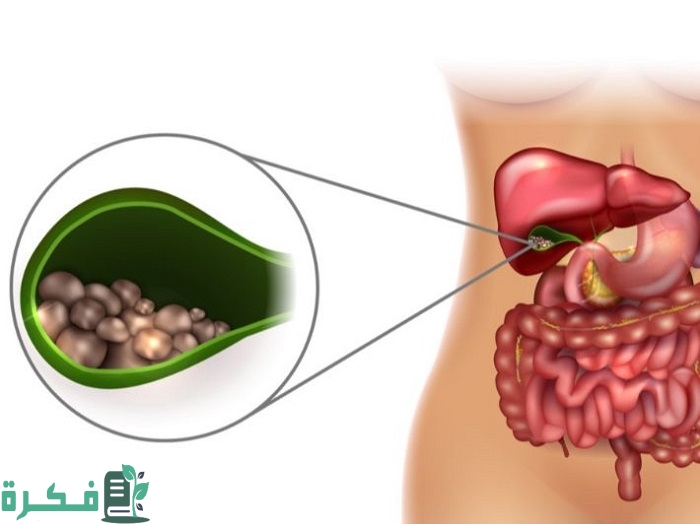 أفضل 5 أعشاب تذيب حصوات المرارة