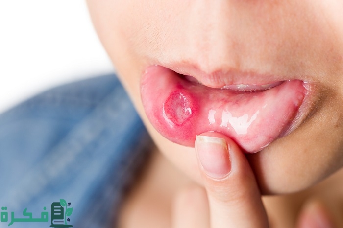 أسماء افضل 5 أنواع جل لعلاج قروح الفم 7 أفضل 5 أنواع جل لعلاج قروح الفم