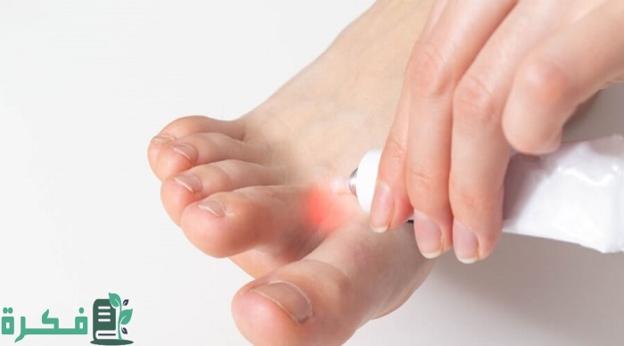 أسماء افضل 5 أنواع كريم لعلاج فطريات أصابع القدم 10 أفضل 5 أنواع كريم لعلاج فطريات أصابع القدم