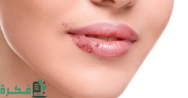 أسماء افضل 5 أنواع مرهم لتقرحات الشفايف 45 أفضل 5 أنواع مرهم لتقرحات الشفايف