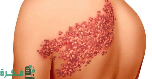 أفضل 5 أنواع مرهم لعلاج الحزام الناري