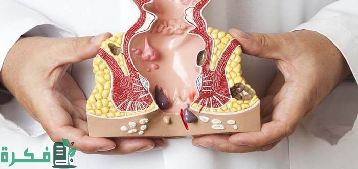 أفضل 5 حبوب مسكنة للبواسير