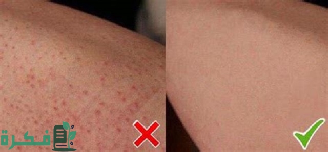 شرح خطوات إزالة الشعر تحت الجلد في الساقين 4 طرق تعرفي عليها 3 كيفية إزالة الشعر تحت الجلد في الساقين