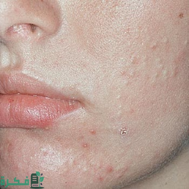 أسباب الحبوب تحت الجلد في الوجه