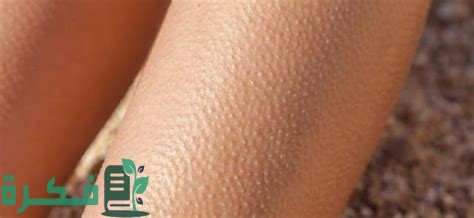 أفضل الكريمات الطبية والمرطبات لعلاج مشكلة جلد الدجاجة